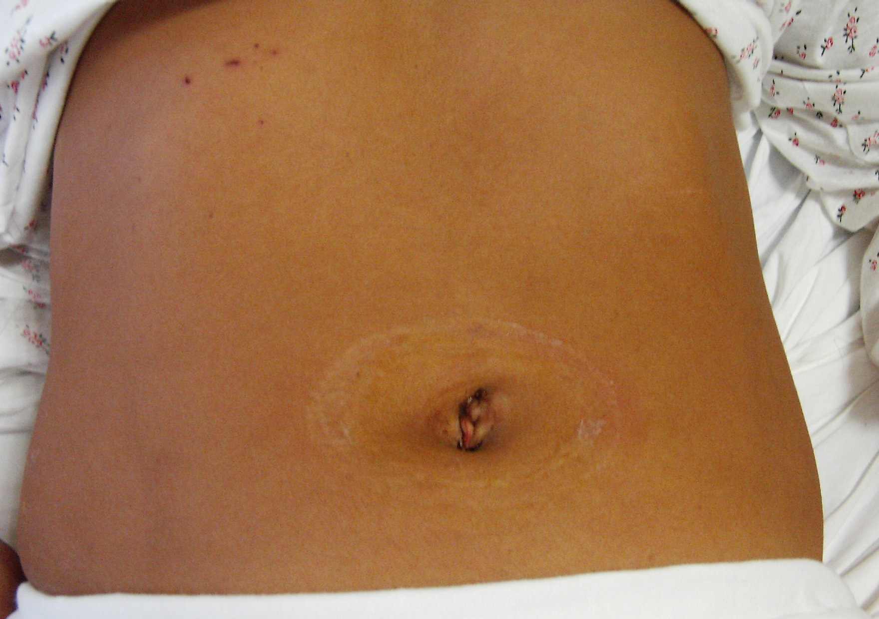 Addome di una paziente dopo intervento di colecistectomia con tecnica "Single Incision".